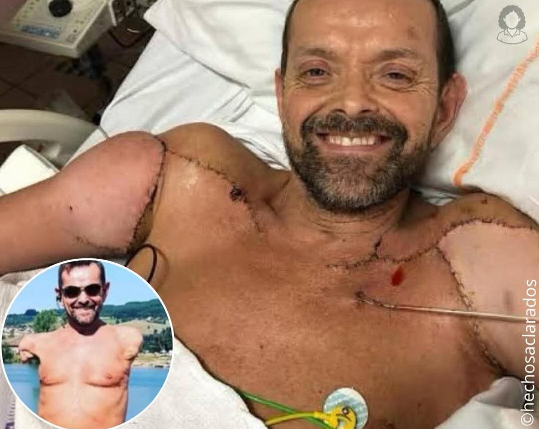 El Primer Trasplante Simultáneo de Brazos y Hombros del Mundo: Un Hito Histórico de la Medicina Moderna